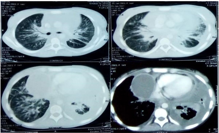 图1：胸部CT肺窗显示实变，肺中区和下叶有空气支气管征。纵隔窗（右下）显示大量心包积液、包膜积液