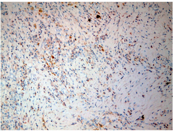 图 3：免疫组织化学显示IgG4阳性浆细胞数量增加