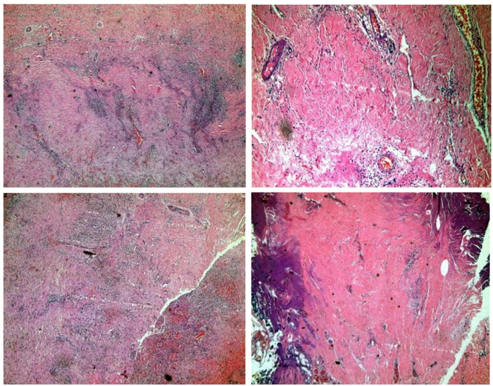 图2：心包病理显示席纹状纤维化伴过量淋巴浆细胞浸润
