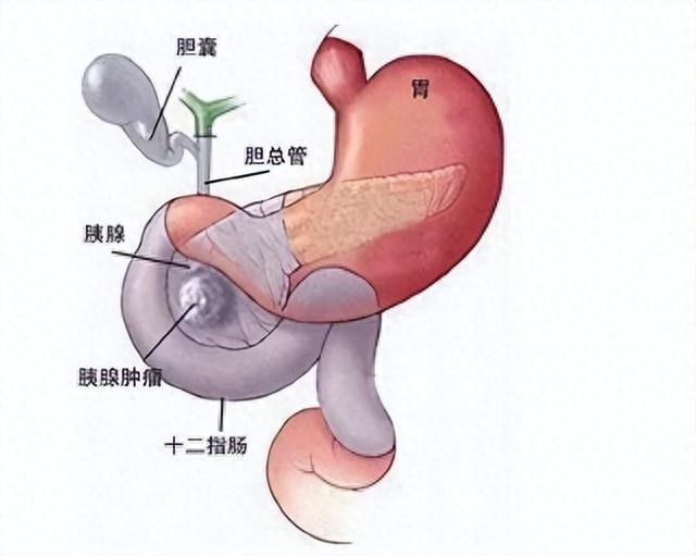 45岁男确诊胰腺癌糖尿病友易患胰腺癌吗要怎么预防