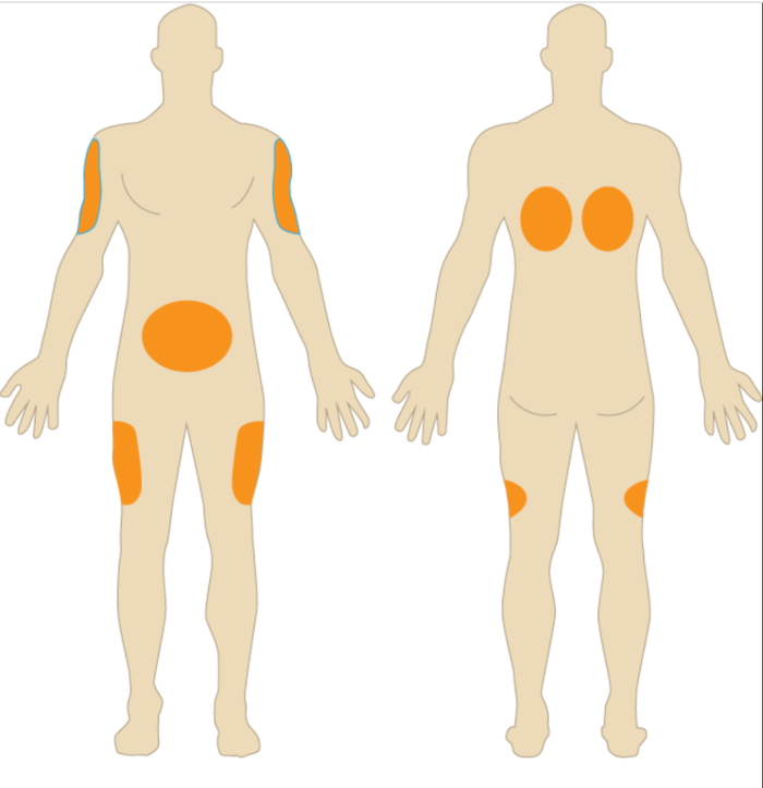 皮下注射区域，图片来源：wikimedia