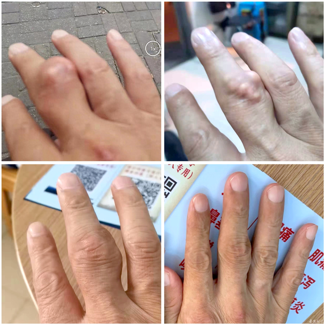 积极配合治疗后,51岁阿叔手上的"小石头"不见了|小石头|痛风石|尿酸