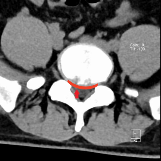 图2：小阳的腰间盘CT，椎体的后缘弧形向下，腰5/骶1椎间盘膨出并偏右后方突出 