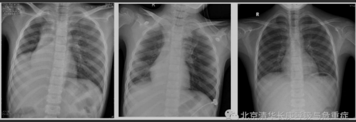 术前、术后当天以及术后十天女童胸片对比