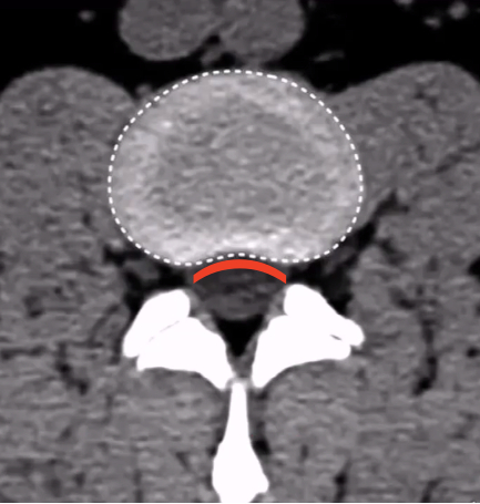 图1：正常腰间盘CT，椎体的后缘弧形向上 