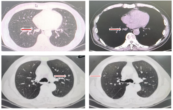 图8 第4阶段双肺结节变化情况