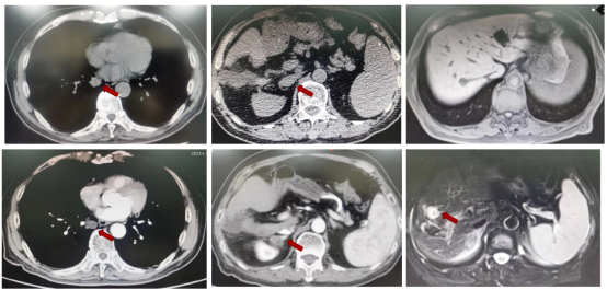 图11 2023年1月、4月胸部CT及上腹部MRI