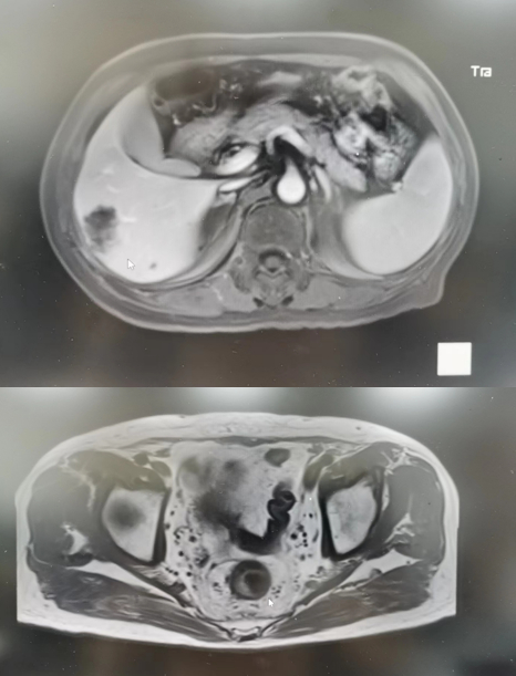 图3 腹部MRI（上）、盆腔MRI（下）