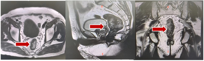 图1 2021年04月26日盆腔MRI
