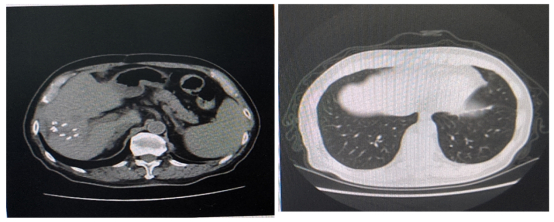 图6 2022年2月胸部CT