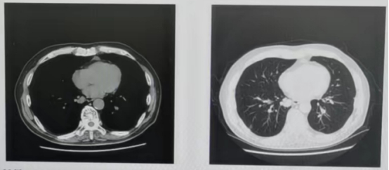 图9 第五阶段双肺结节变化情况