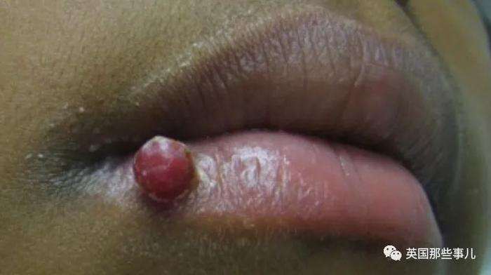 孕妇吃饭时咬到嘴唇,竟长成肿瘤长达4个月?医生:过于罕见!