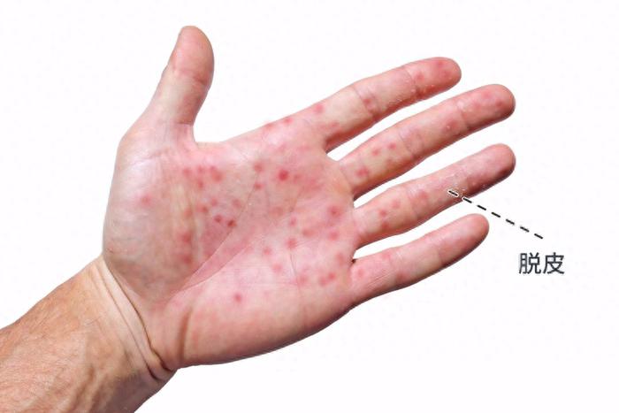 三期梅毒是最严重的阶段,患者会出现皮肤和黏膜的损伤,其中最典型的是