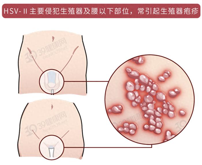 6个常见性病,男女都该知道