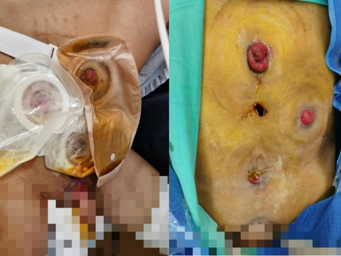 董先生术前腹部的瘘口护理情况