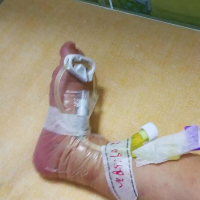 留置针|导管|输液_新浪新闻