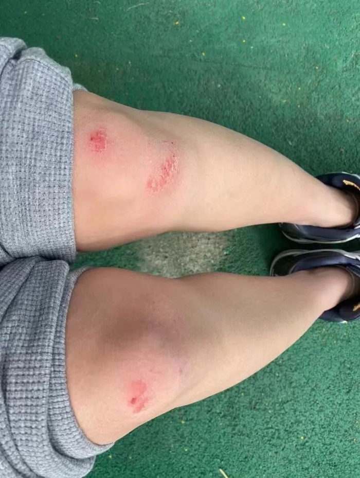 陈妍被点名要求跑步,摔伤双腿 / 受访者供图