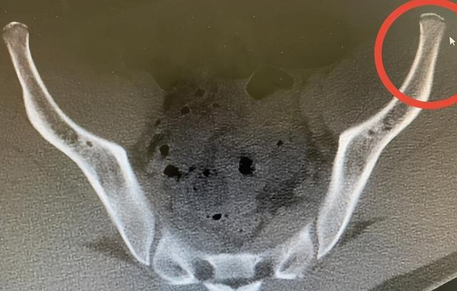 别让"髂前上棘 " 骨折成为肆意奔跑的"牵绊"|骨折|跑步|骨科_新浪新闻