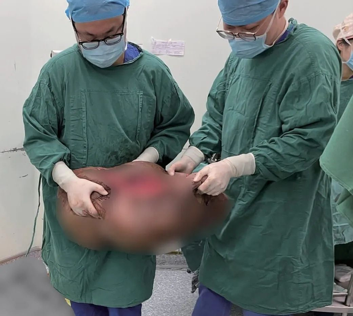 日前，上海交通大学医学院附属第九人民医院泌尿外科修复重建团队切除了巨大的阴茎阴囊象皮肿，重52斤。（图源：受访者提供）