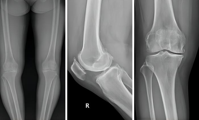 图：术前膝关节正侧位X线，右膝关节内侧间隙狭窄