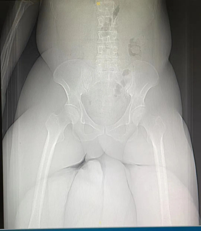 Z先生的阴茎阴囊象皮肿过于巨大，CT只能照射到部分肿块。（图源：受访者提供）