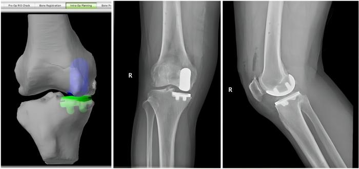 图：术中模拟假体安装位置 VS 术后膝关节正侧位X线显示假体位置满意，与术中模拟图基本相同
