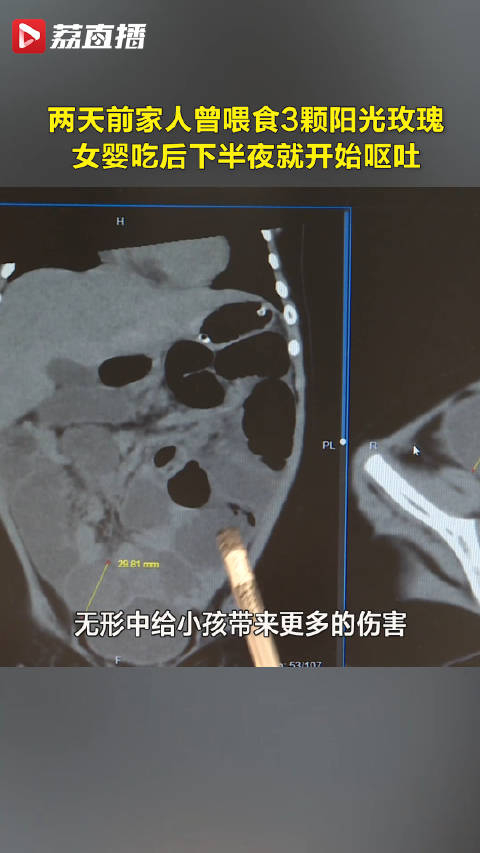 女婴被投喂3颗阳光玫瑰致肠梗阻