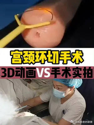 3d动画演示宫颈环切手术是怎么做的