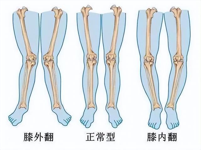 髋内翻和髋外翻图片图片