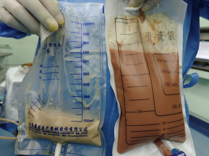 跨越千里探囊取液精准穿刺引流近千毫升脓液救治多囊肾患者