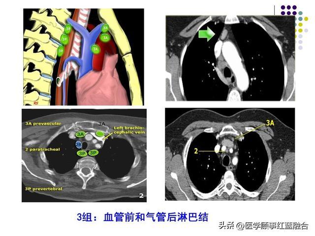 縱隔內見腫大淋巴結怎麼回事|肺結核_新浪新聞