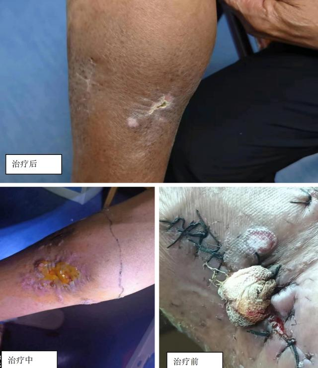 七旬老人腿部出现"皮肤肿块"经久不愈,医生精心救治为其保住腿|肿瘤