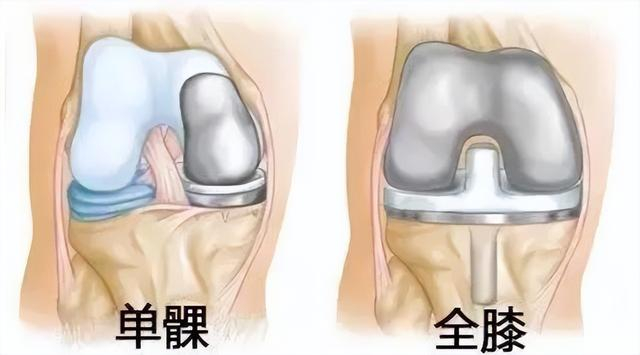 2,创伤小仅切除磨损软骨及半月板,保留原有韧带结构;术后步态更接近