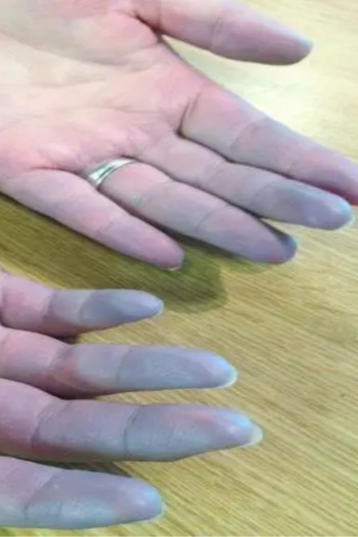 手指变白变紫天冷后有这些情况可能是疾病前兆女性更容易中招