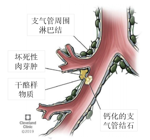 两次登上顶刊关于支气管结石这些你不可不知