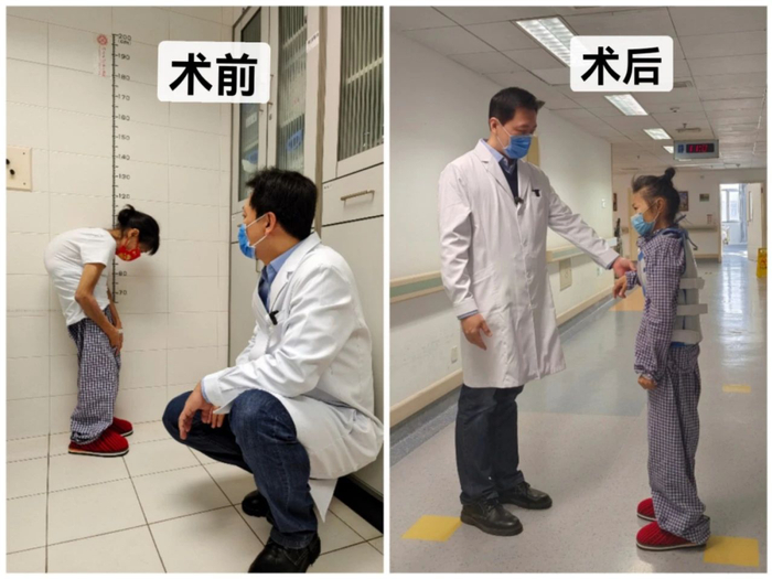 王宇和脊柱侧弯患者（术前术后对比）/受访者供图
