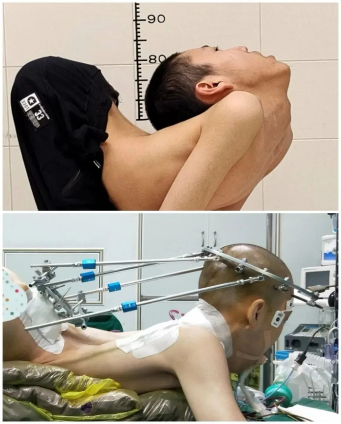 姜延琛第一次手术前后对比/受访者供图