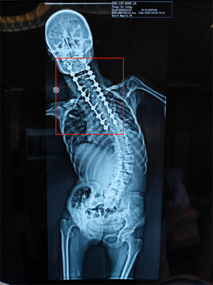 童福容第一次手术后，红色部分为固定脊柱的螺钉