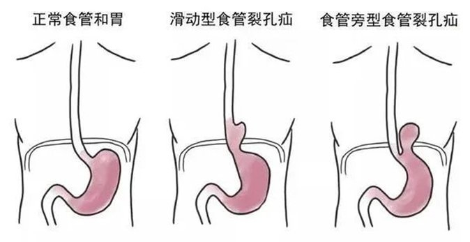 反复烧心腹痛竟是胃食管反流 腹腔镜下食管裂孔疝修补解除患者病痛
