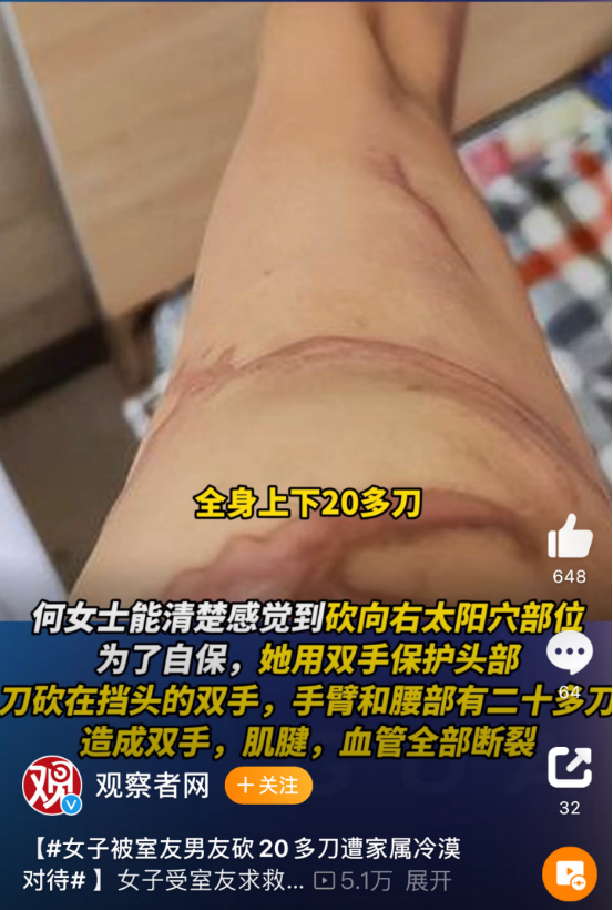 双手被刀割断了肌腱和血管,腰部也有一道深深的刀痕.