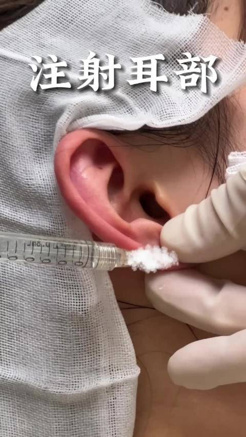 一组注射耳部即刻效果贴面耳想要耳朵轮廓好看显脸小