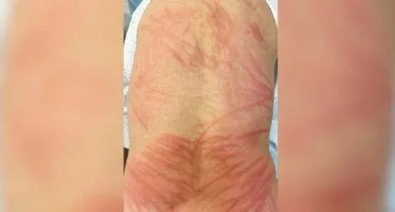 72 岁老人的背部和臀部上部出现的鞭状红斑，图片来源于《新英格兰医学杂志》