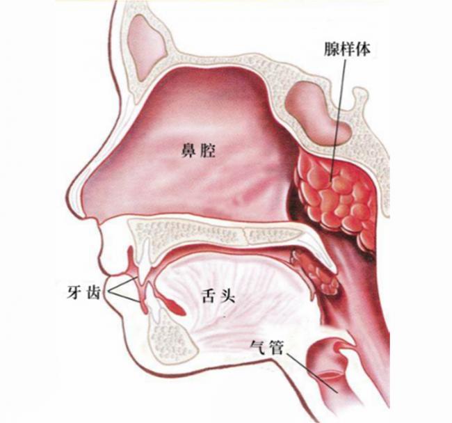 腺样体肥大位置图片