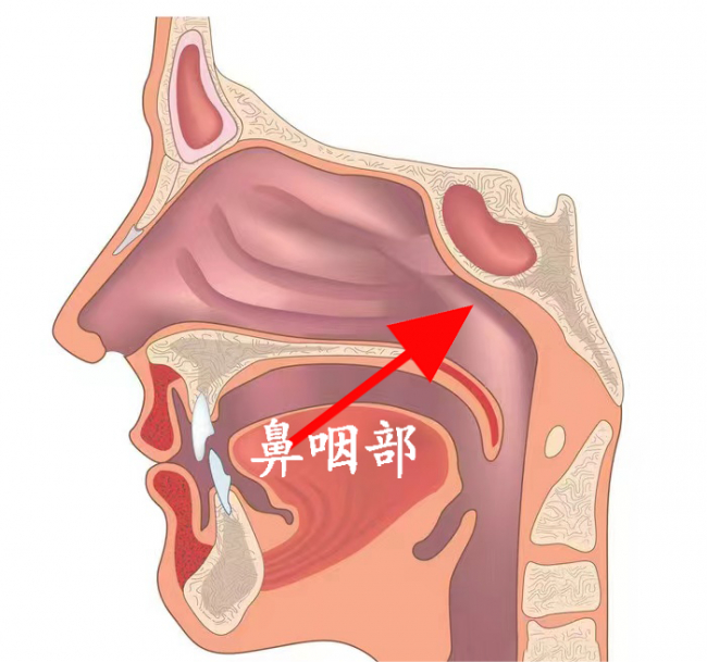 沈阳民生耳鼻喉医院:腺样体肥大怎么办?