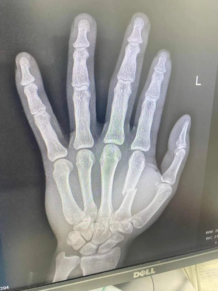 中国硬汉骨折血拼对手!x光触目惊心!|骨折_新浪新闻