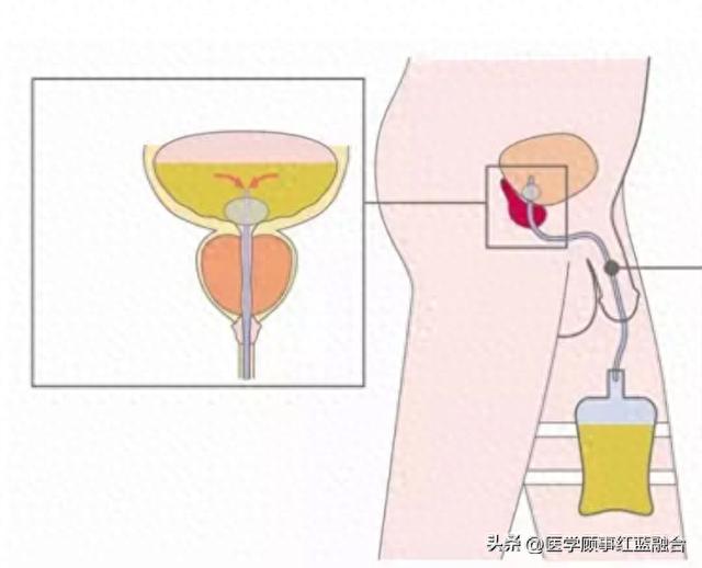 拔尿管步骤图解拔出来图片