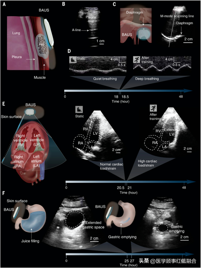 超声骨刀企业盘点 锐锋医疗实力解析