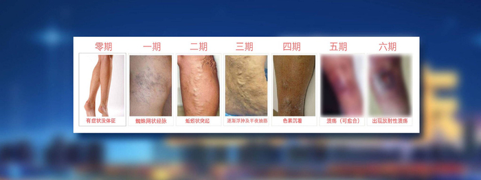 静脉曲张|手术|山东队_新浪新闻