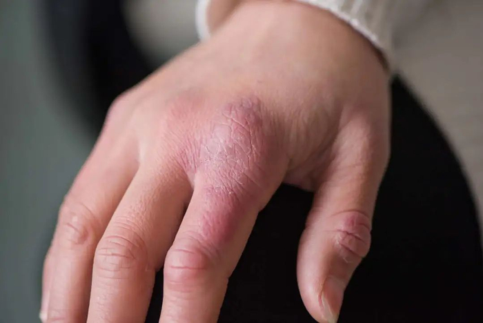 冻疮又紫又红,状似萝卜,因此长了冻疮的手又俗称为"萝卜手" / 图虫