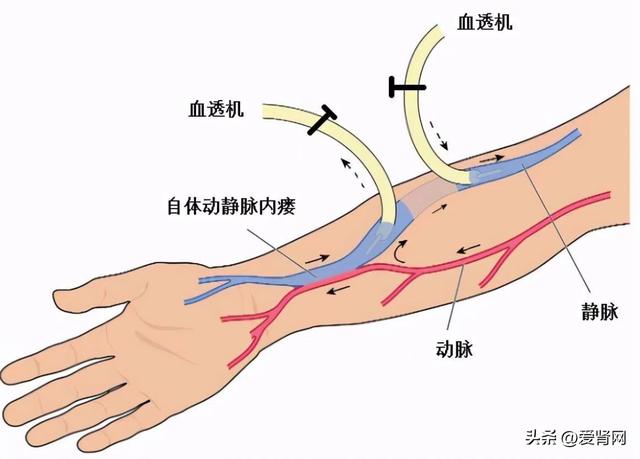 揭晓最适合透析肾友的穿刺法,学会生命线可多用30年!